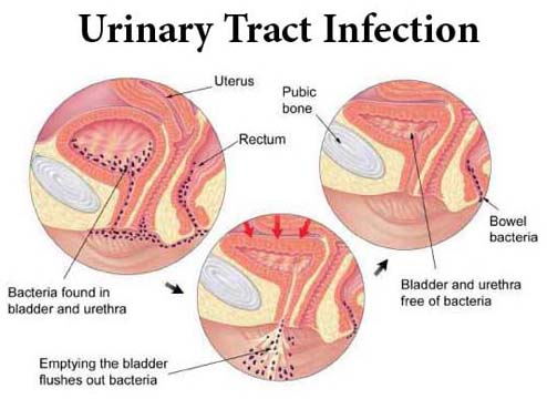 Urinary Track Infection UTI